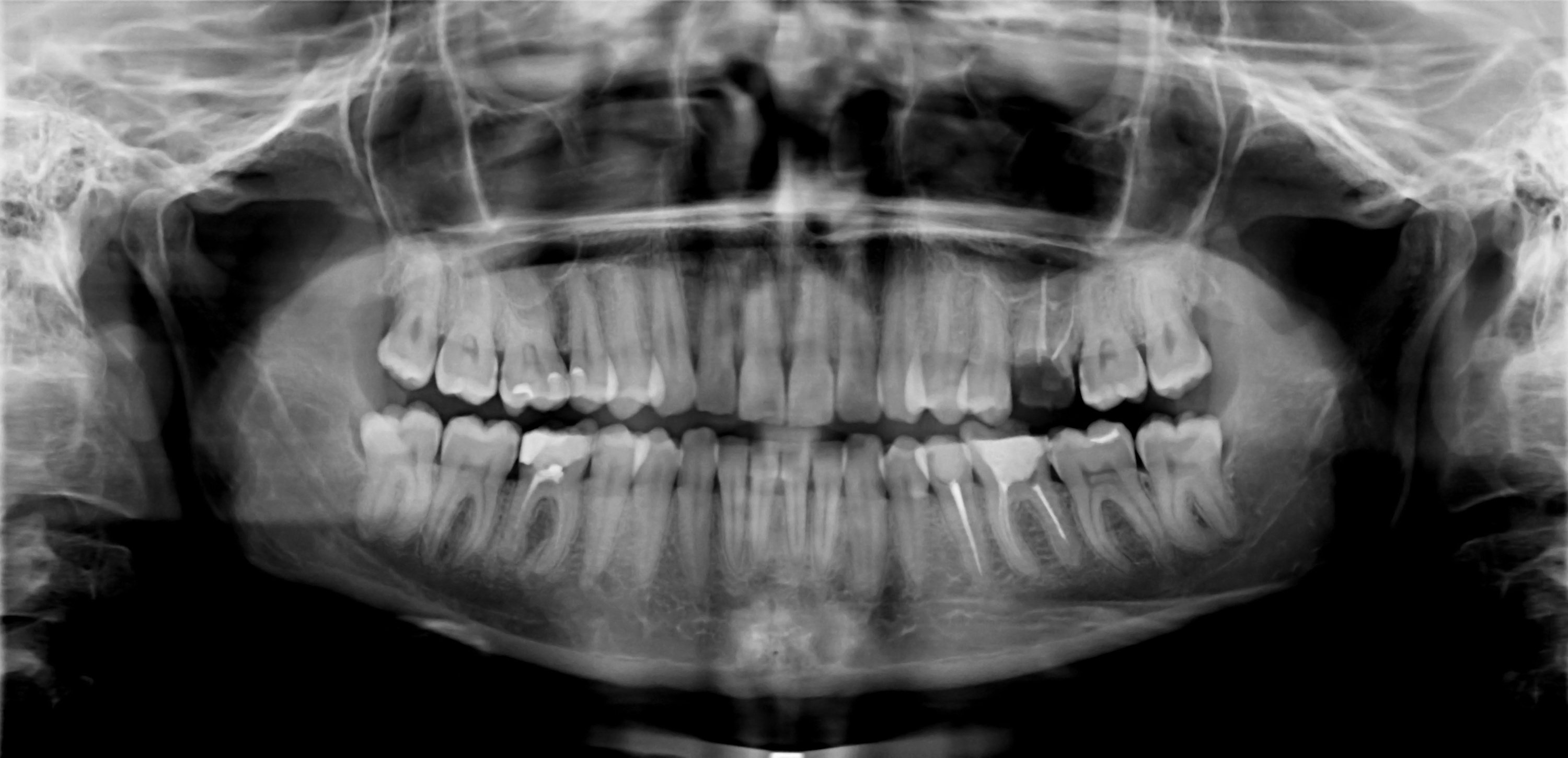 Panoramic Shot of Black and White X-Ray Teeth Scan Mandible